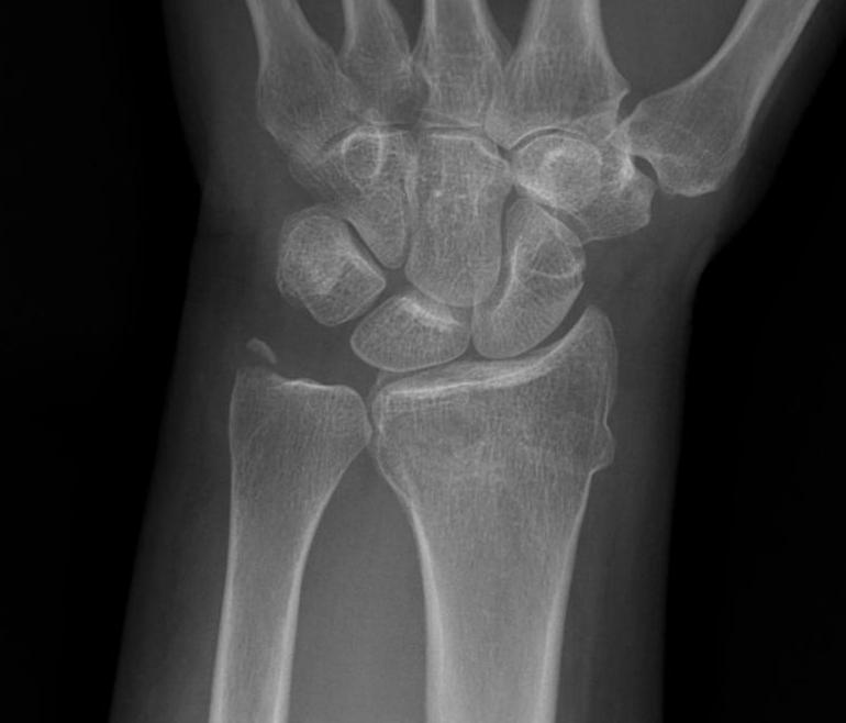 Ulna Styloid Tip Fracture